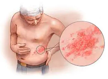 Профилактика опоясывающего лишая